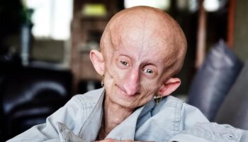 Muere a los 19 años la influencer Beandri Booysen, enferma de progeria