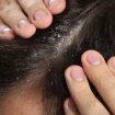 NHS warns dandruff sufferers to buy shampoo with specific ingredient to fix it