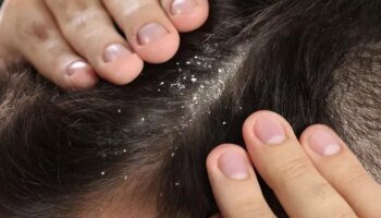 NHS warns dandruff sufferers to buy shampoo with specific ingredient to fix it