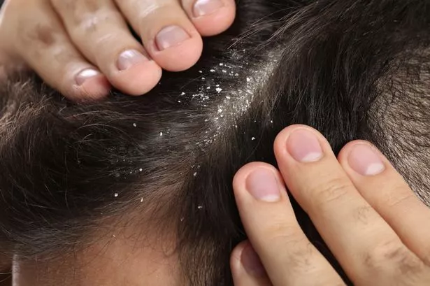 NHS warns dandruff sufferers to buy shampoo with specific ingredient to fix it