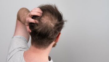 ‘I’m a nutritionist, these are five foods that could prevent baldness’