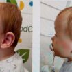 Flat head syndrome affects up to 40% of babies - but what is it and do helmets work?