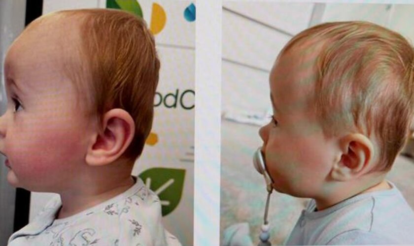 Flat head syndrome affects up to 40% of babies - but what is it and do helmets work?