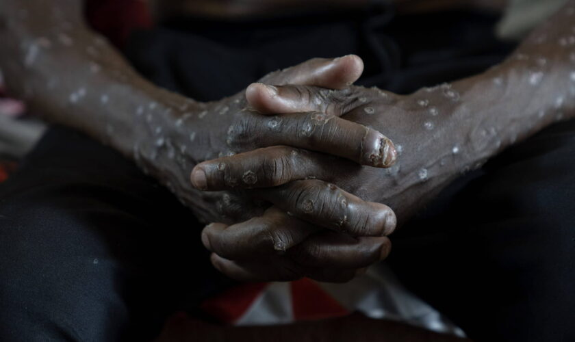 Symptômes, variant, situation en France... 4 questions sur le mpox