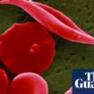 NHS error meant hundreds of parents did not know children’s sickle cell status