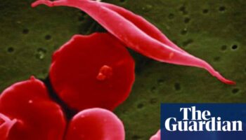 NHS error meant hundreds of parents did not know children’s sickle cell status