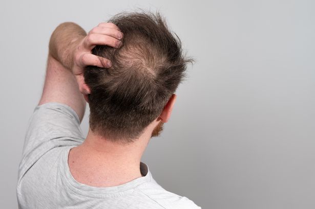 ‘I’m a nutritionist, these are five foods that could prevent baldness’